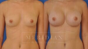 tjelmeland-meridian-austin-breast-augmentation-patient-32-1