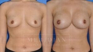 tjelmeland-meridian-austin-breast-augmentation-patient-33-1