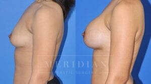 tjelmeland-meridian-austin-breast-augmentation-patient-33-2