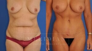 tjelmeland-meridian-austin-breast-augmentation-patient-34-1