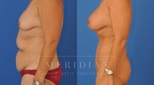 tjelmeland-meridian-austin-breast-augmentation-patient-34-2