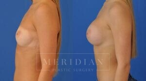 tjelmeland-meridian-austin-breast-augmentation-patient-37-2