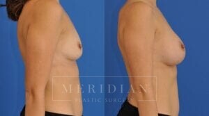 tjelmeland-meridian-austin-breast-augmentation-patient-38-2