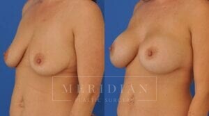 tjelmeland-meridian-austin-breast-augmentation-patient-39-2