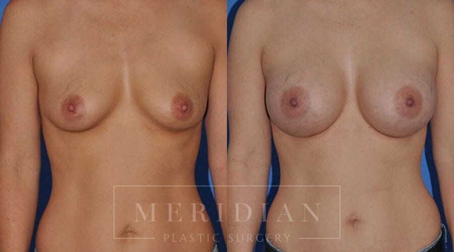 tjelmeland-meridian-austin-breast-augmentation-patient-4-1