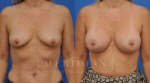 tjelmeland-meridian-austin-breast-augmentation-patient-40-1