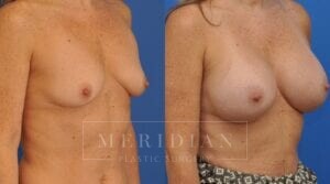 tjelmeland-meridian-austin-breast-augmentation-patient-40-2