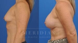tjelmeland-meridian-austin-breast-augmentation-patient-40-3