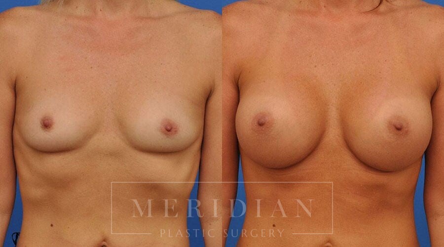 tjelmeland-meridian-austin-breast-augmentation-patient-41-1