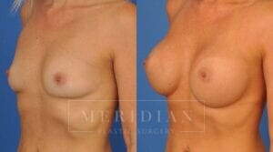 tjelmeland-meridian-austin-breast-augmentation-patient-41-2