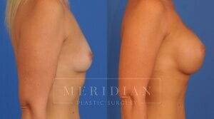 tjelmeland-meridian-austin-breast-augmentation-patient-41-3