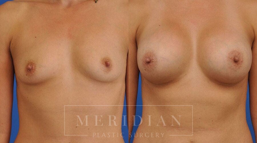 tjelmeland-meridian-austin-breast-augmentation-patient-42-1