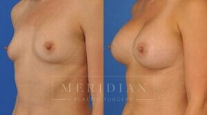 tjelmeland-meridian-austin-breast-augmentation-patient-42-2