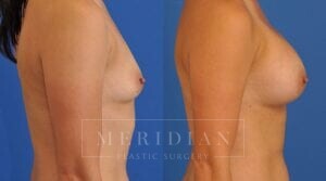 tjelmeland-meridian-austin-breast-augmentation-patient-42-3