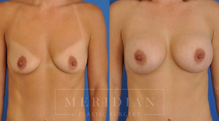 tjelmeland-meridian-austin-breast-augmentation-patient-5-1