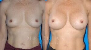 tjelmeland-meridian-austin-breast-augmentation-patient-6-1