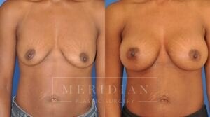 tjelmeland-meridian-austin-breast-augmentation-patient-7-1