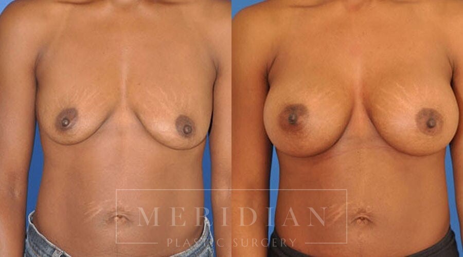 tjelmeland-meridian-austin-breast-augmentation-patient-7-1