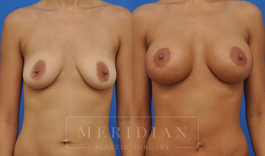 tjelmeland-meridian-austin-breast-lift-patient-1-1