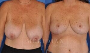 tjelmeland-meridian-austin-breast-lift-patient-10-1