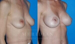 tjelmeland-meridian-austin-breast-lift-patient-11-2