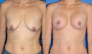 tjelmeland-meridian-austin-breast-lift-patient-12-1