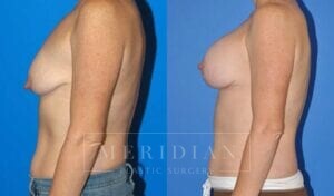 tjelmeland-meridian-austin-breast-lift-patient-12-2