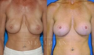 tjelmeland-meridian-austin-breast-lift-patient-13-1