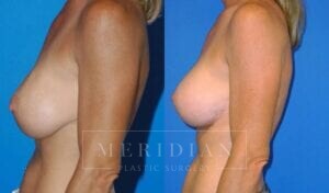 tjelmeland-meridian-austin-breast-lift-patient-13-2