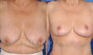 tjelmeland-meridian-austin-breast-lift-patient-14-1