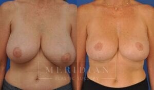 tjelmeland-meridian-austin-breast-lift-patient-15-1