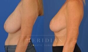 tjelmeland-meridian-austin-breast-lift-patient-15-2