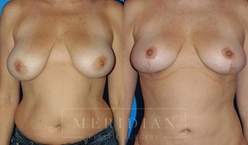 tjelmeland-meridian-austin-breast-lift-patient-2-1
