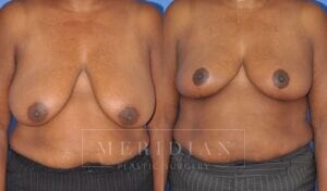 tjelmeland-meridian-austin-breast-lift-patient-3-1