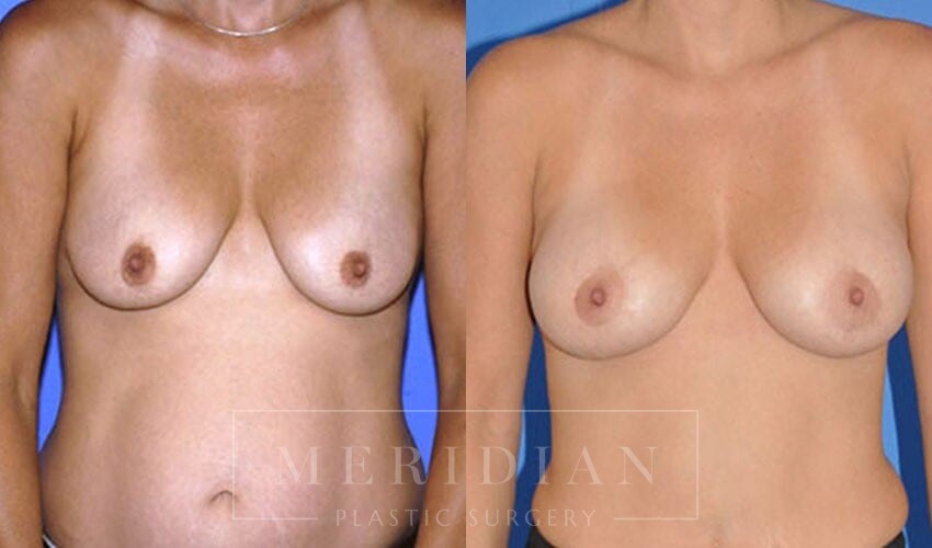 tjelmeland-meridian-austin-breast-lift-patient-4-1