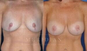 tjelmeland-meridian-austin-breast-lift-patient-6-1