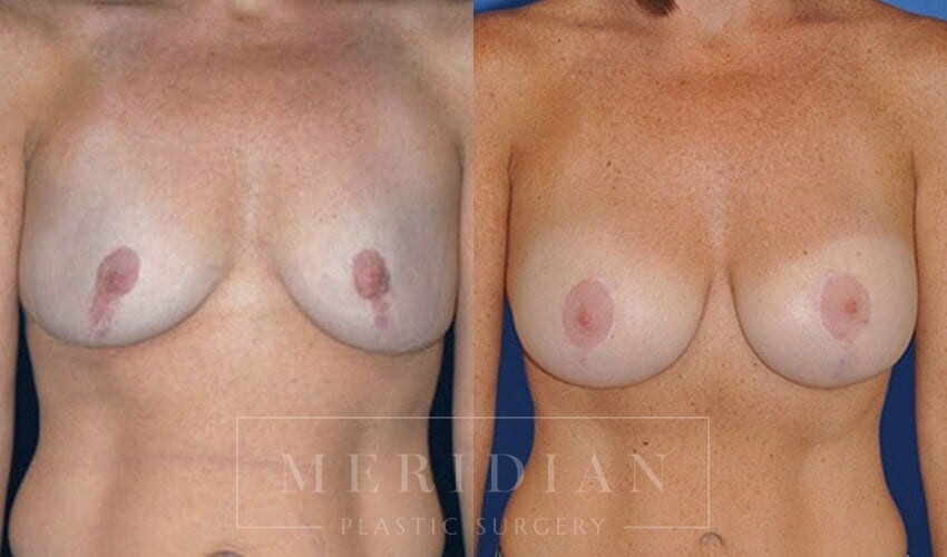 tjelmeland-meridian-austin-breast-lift-patient-6-1
