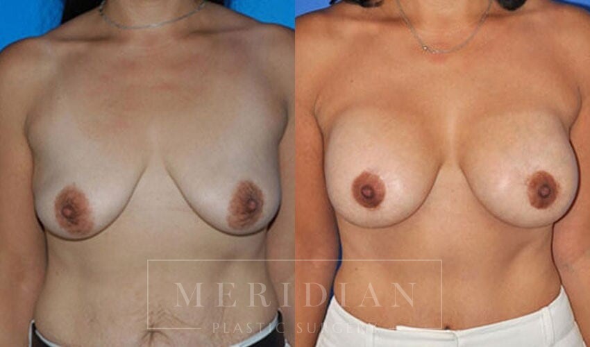 tjelmeland-meridian-austin-breast-lift-patient-7-1