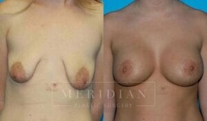 tjelmeland-meridian-austin-breast-lift-patient-8-1