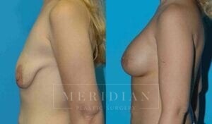 tjelmeland-meridian-austin-breast-lift-patient-8-2