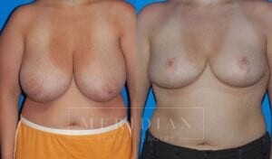tjelmeland-meridian-austin-breast-reduction-patient-1-1