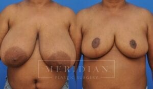tjelmeland-meridian-austin-breast-reduction-patient-10-1