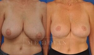 tjelmeland-meridian-austin-breast-reduction-patient-11-1
