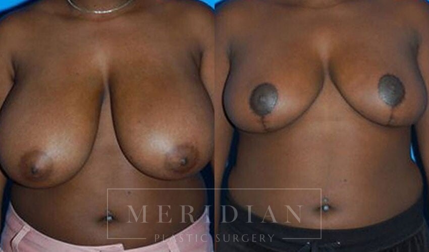 tjelmeland-meridian-austin-breast-reduction-patient-2-1