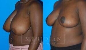 tjelmeland-meridian-austin-breast-reduction-patient-2-2