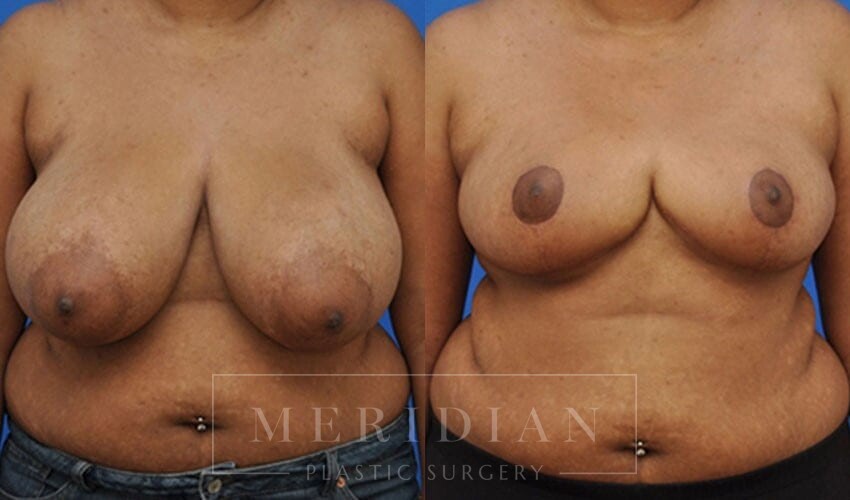 tjelmeland-meridian-austin-breast-reduction-patient-4-1