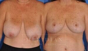 tjelmeland-meridian-austin-breast-reduction-patient-5-1