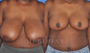 tjelmeland-meridian-austin-breast-reduction-patient-8-1