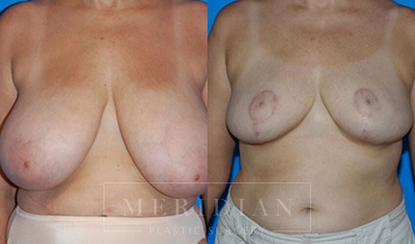 tjelmeland-meridian-austin-breast-reduction-patient-9-1
