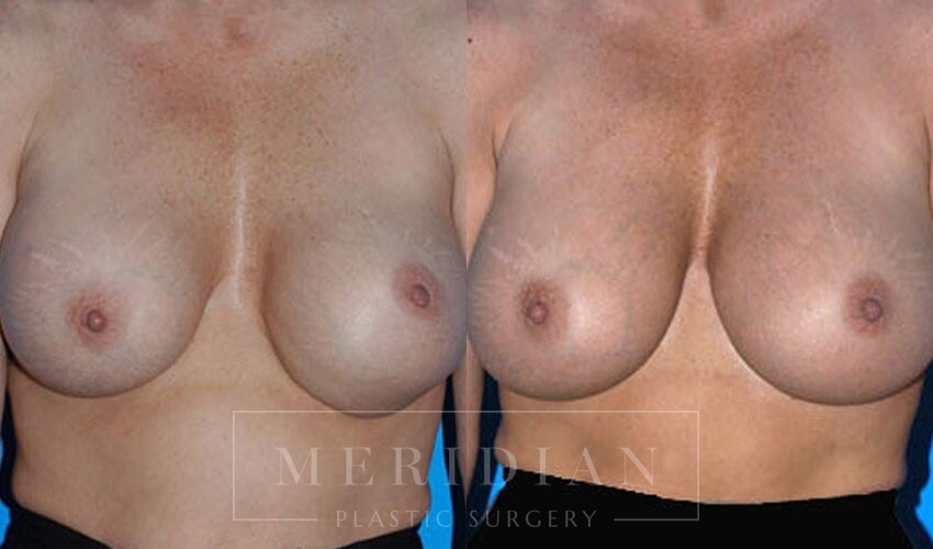 tjelmeland-meridian-austin-breast-revision-patient-1-1